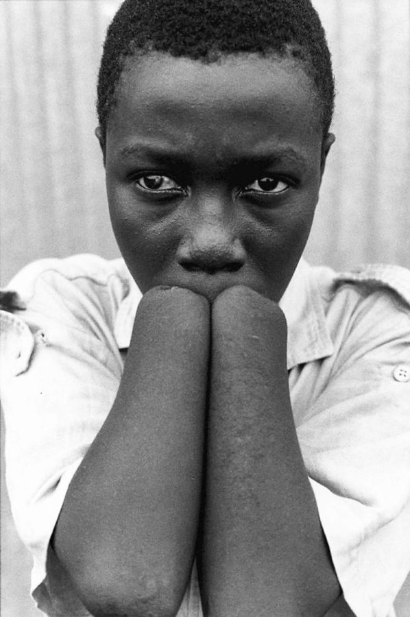 A 17-year old with hands amputated by rebels machetes, Waterloo camp, Sierra Leone. 1998. Photo Courtesy: UNICEF