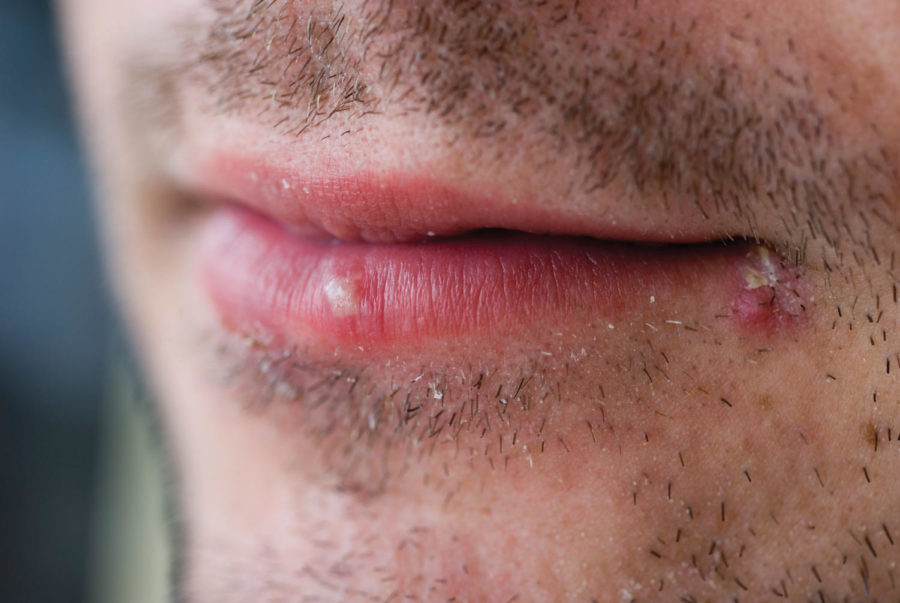 Cold sores (herpes labialis)
