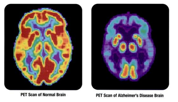 ISU researcher Auriel Willette is studying the link between insulin resistance and Alzheimers disease. The scan on the left is a normal brain, while the scan on the right is from an Alzheimers diseased brain.