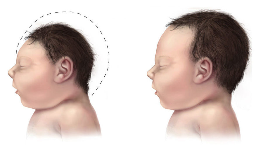 A baby with microcephaly, effect of the Zika virus, compared to a baby with a typical head size.